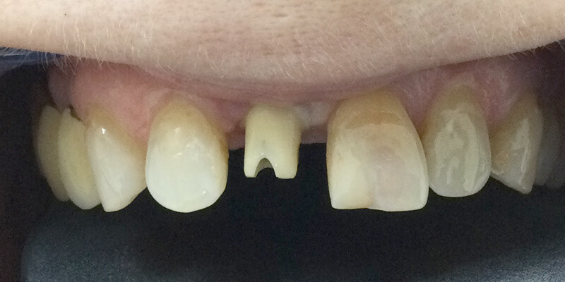 Detailaufnahme der oberen 6 Zähne im Oberkiefer, zeigt eine in der Lücke des mittleren rechten Schneidezahns (Zahn 11) auf einem Implantat platziertem Abutment (auch Pfosten genannt) aus Zirkonkeramik. Auf diesem Abutment wird später die Keramikkrone aufgesetzt. Die restlichen Zähne sind vollständig und sichtbar.