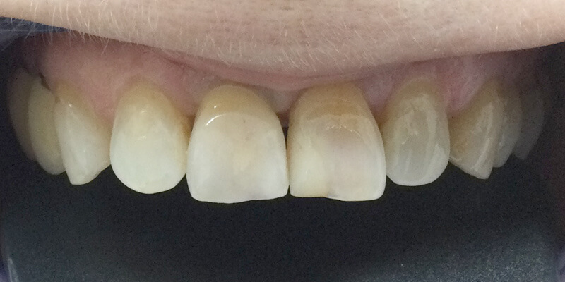Detailaufnahme der oberen 6 Zähne im Oberkiefer, zeigt eine versorgte Lücke des mittleren rechten Schneidezahns (Zahn 11) durch eine vollkeramische Krone auf einem Implantat. Behandelnder Zahnarzt Dr. Mihail Cos aus Hannover, ausführendes Labor: Dentallabor Kretschmer in Hannover