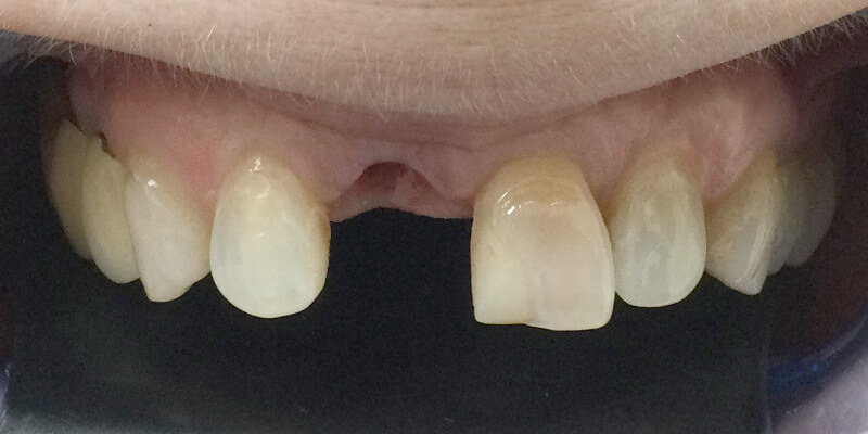 Detailaufnahme der oberen 6 Zähne im Oberkiefer, zeigt eine Lücke an der Stelle des mittleren rechten Schneidezahns (Zahn 11). Die restlichen Zähne sind vollständig und sichtbar.