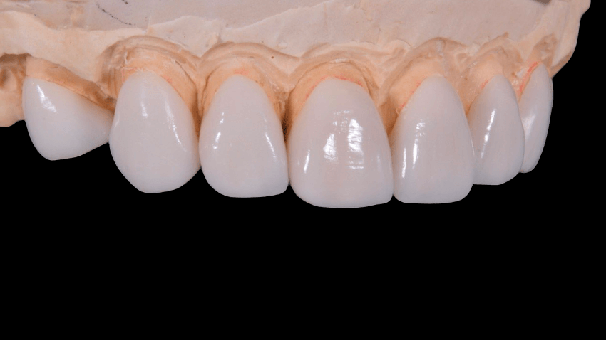 Modell eines Gebisses mit Kronen aus Vollkeramik, die eine natürliche Ästhetik und präzise Passform zeigen. Die Kronen sind auf den Zähnen eines kieferförmigen Modells platziert