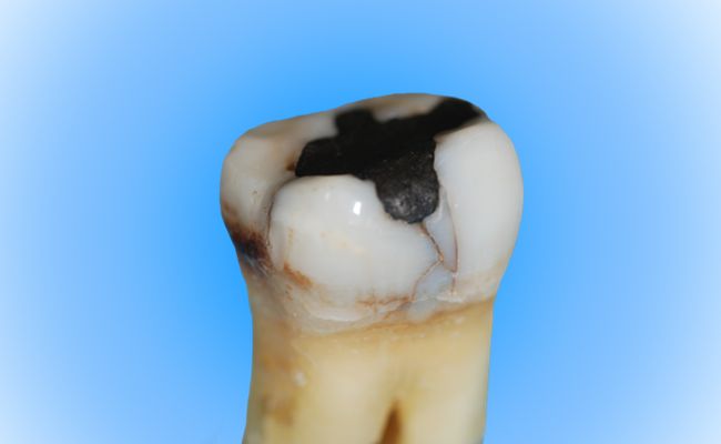 Amaögamfüllung im Zahn