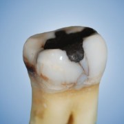 Eine alte Amalgamfüllung im Zahn