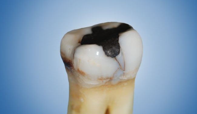 Eine alte Amalgamfüllung im Zahn