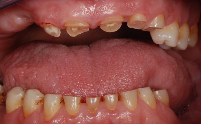 Abrasionsgebiss nach Zähneknirschen-Bruxismus