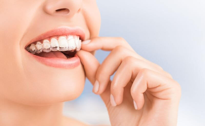 Moderne Kieferorthopädie: Junge Frau setzt eine transparente Invisalign-Zahnschiene für die Korrektur von Zahnfehlstellungen auf ihre oberen Zähne ein, mit einem Lächeln im Gesicht.