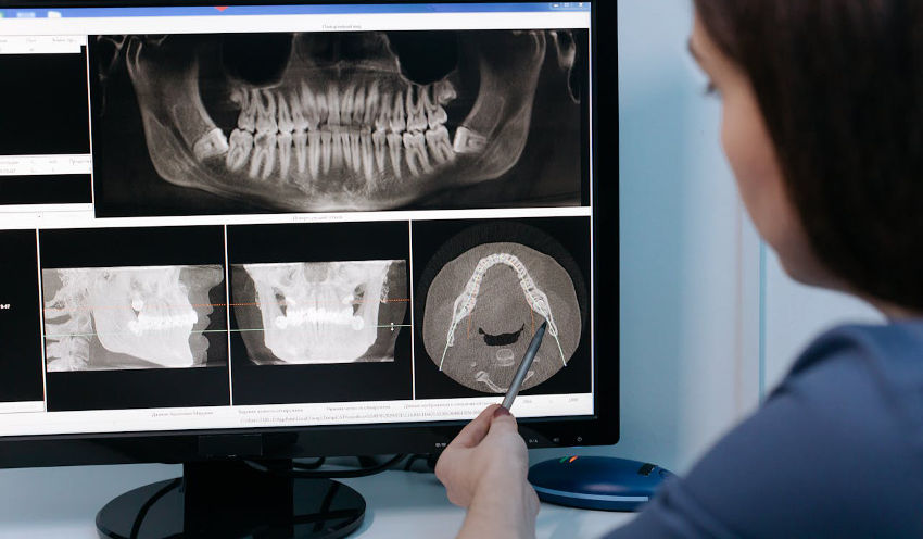 Das Bild zeigt eine Zahnärztin oder zahnmedizinische Fachkraft, die auf einen Computermonitor blickt und mit einem Stift auf eine digitale Röntgenaufnahme zeigt. Auf dem Bildschirm sind verschiedene zahnmedizinische Bildgebungen zu sehen, darunter ein orthopantomographisches Panorama-Röntgenbild (OPG), seitliche Röntgenaufnahmen und eine 3D-Darstellung (vermutlich aus einer DVT – digitale Volumentomographie). Die Person analysiert offensichtlich die anatomischen Strukturen des Kiefers, möglicherweise zur Planung einer Implantation oder Diagnose.