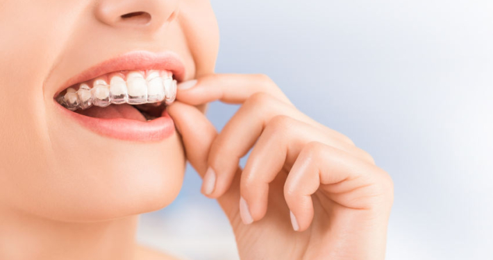 Eine Frau setzt sich mit den Fingern einen transparenten Clear Aligner auf die Zähne. Man sieht ein Lächeln mit weißen Zähnen und die fast unsichtbare Kunststoffschiene, die sanft über die Zahnreihe geschoben wird. Das Bild vermittelt den diskreten, ästhetischen Charakter einer Aligner-Behandlung.