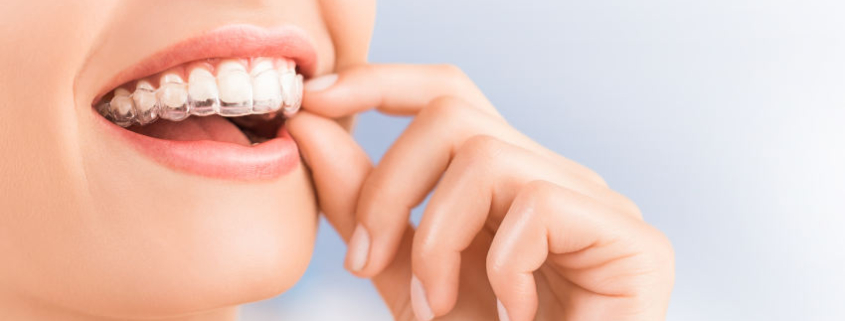Eine Frau setzt sich mit den Fingern einen transparenten Clear Aligner auf die Zähne. Man sieht ein Lächeln mit weißen Zähnen und die fast unsichtbare Kunststoffschiene, die sanft über die Zahnreihe geschoben wird. Das Bild vermittelt den diskreten, ästhetischen Charakter einer Aligner-Behandlung.