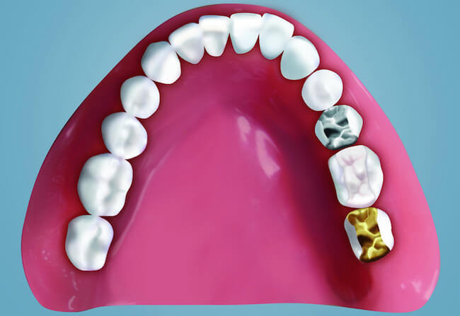Zahn grau verfärbt
