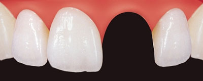 Zahnlücke der Frontzähne