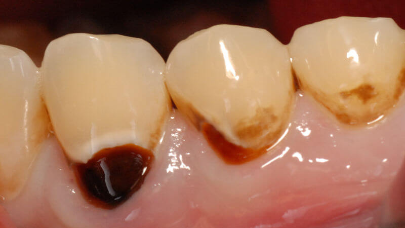 3 Zähne im Unterkiefer die Karies in verschiedenen Stadien von Initialkaries bis fortgestrittenem Karies im Zahnhalsbereich aufweisen