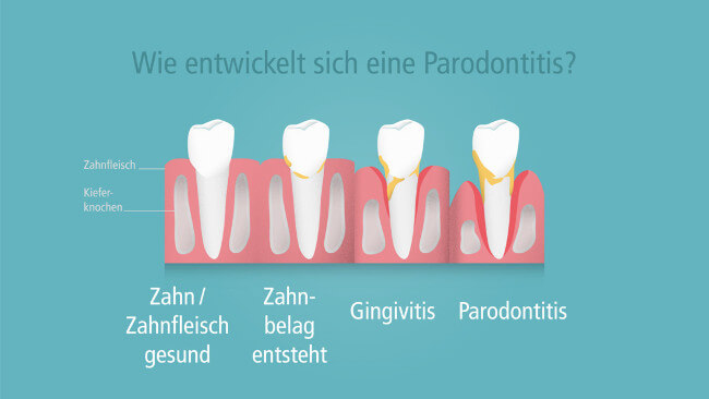 Wie entwickelt sich eine Parodontitis? Die vier Stadien einer Parodontitis als Grafik dargestellt