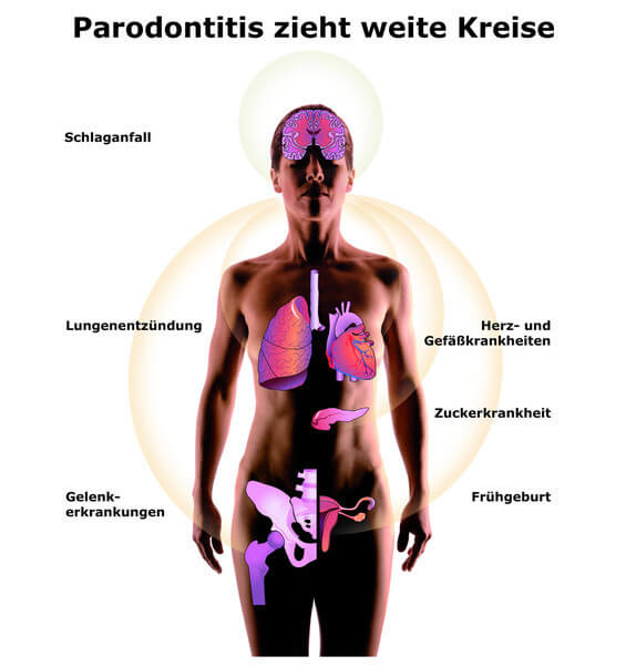 Der Kreislauf des Parodontitis und die Auswirkungen dieser auf die inneren Organe des Menschen