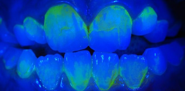 Zahnbelag beim Kind unter UV-Licht