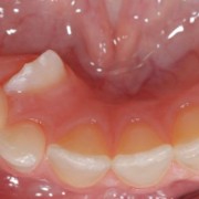 Zahnfehlstellung-Ein persistierender Milchzahn